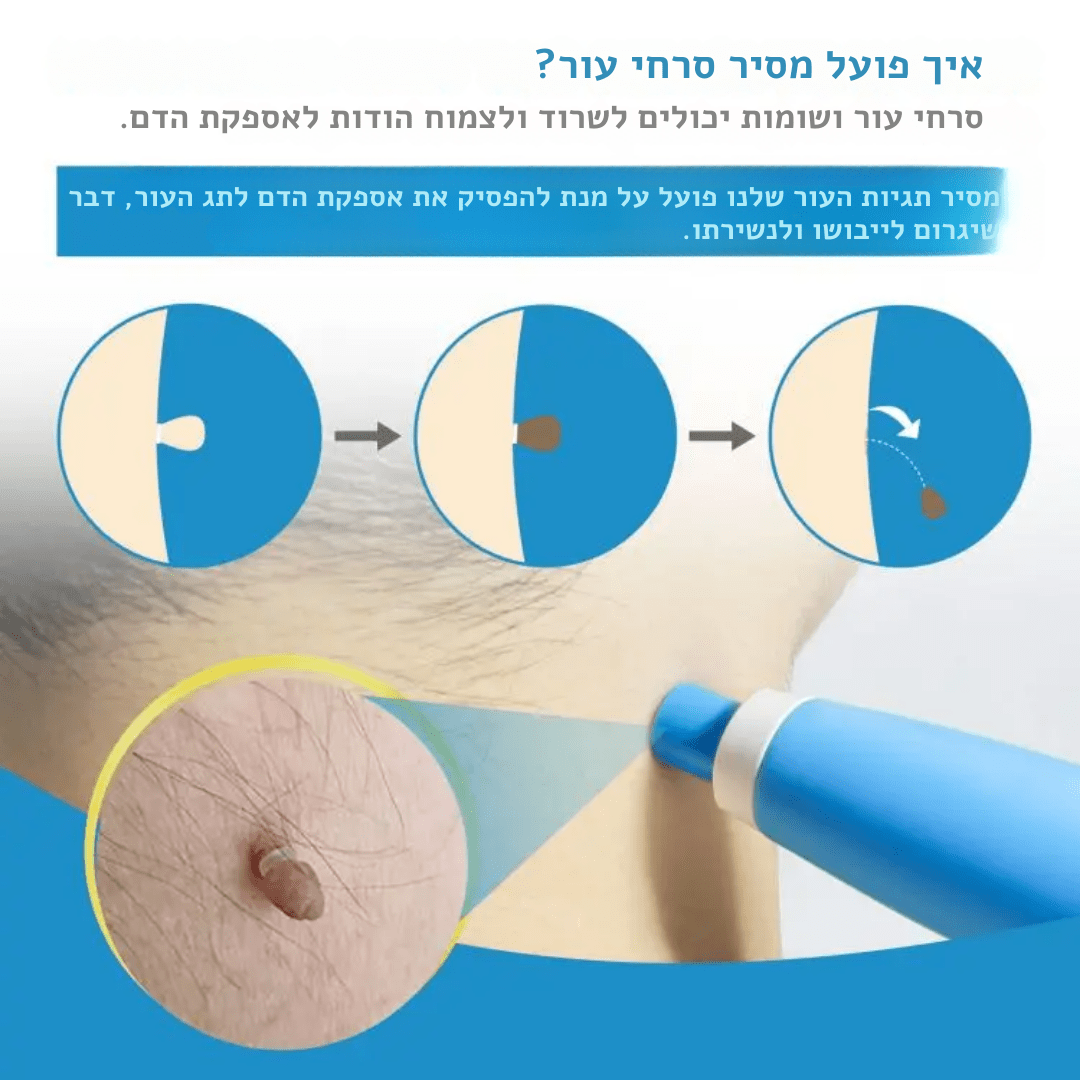 SEFUDUN – ערכת הסרת סרחי עור, שומות ופלולות אוטומטית | ערכת הסרת סרחי עור, שומות ופלולות אוטומטית | אוזו - שופ